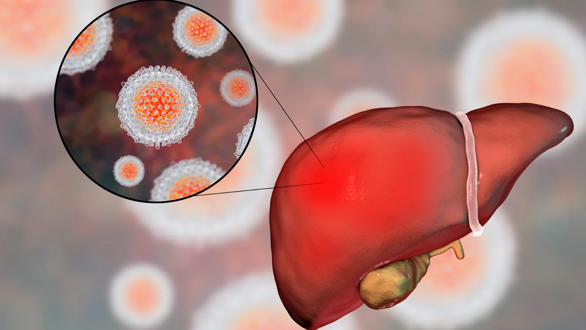 Hepatitis B